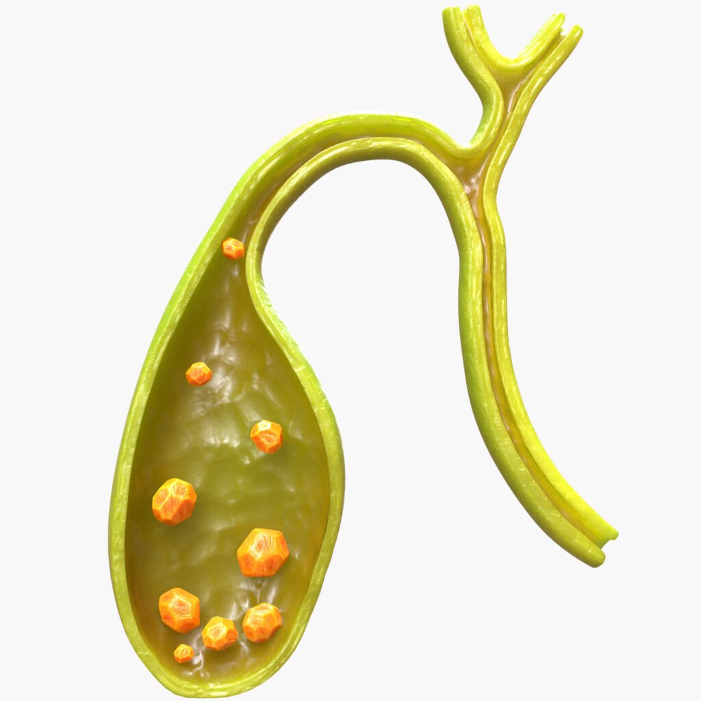Vesicula Colelitiasis Cirugia en Texcoco