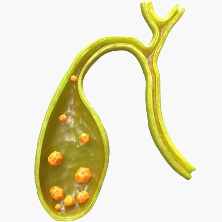 Vesicula Colelitiasis Cirugía en CDMX