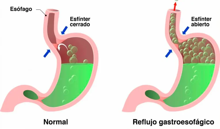 reflujo-TEXCOCO.jpg